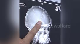 Needles found in woman's head during CT scan after car accident in China