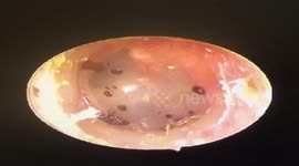 Doctor removes ant from boy's ear in Vietnam