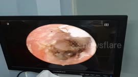 Vietnamese doctor removes mushrooms growing in man's ear after he complained about an itch