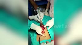 36 sharp edged tools extracted from boy's stomach in northern India