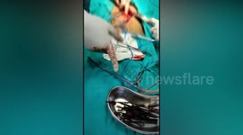 Indian doctors remove 30 iron nails from 18-year-old patient's stomach