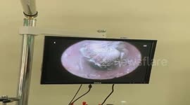 Trapped caterpillar makes cocoon inside man's ear in Vietnam