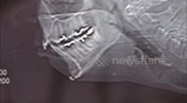 X-ray of nail in head