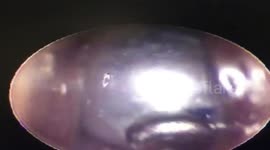 Vietnamese doctor removes pearl from 5-year-old boy's nose