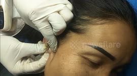 Dermatologist extracts massive 15-year-old blackhead from woman's ear