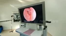 Doctor cleans super glue from man's ear after he mistakes it for ear drops