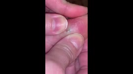 2 part when needle is popped