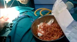 Doctor removes more than 100 parasites from Vietnamese man's abdomen