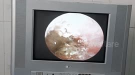 The doctor removed the live tick that was sucking blood from the man's ear for 10 days