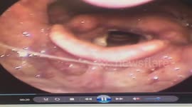 The doctor removed the fishbone longer than 6cm in the patient's throat