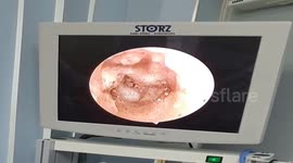 Vietnamese doctor finds dozens of 'mushrooms' growing in patient's ears