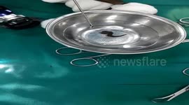Doctor removes giant leech from Vietnamese man's nose