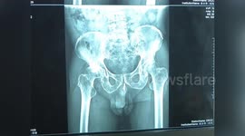 Chinese doctor removes broken metal tube from elderly man's penis