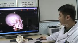 Doctor removes 9-centimetre steel bar from Chinese boy's head