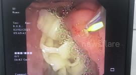Thai doctors remove 7ft long parasite from patient with severe stomach ache