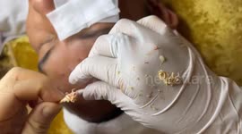 Dermatologist removes pimples from Vietnamese man's forehead