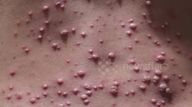 Adult Chicken Pox