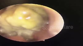 Vietnamese doctor removes giant corn kernel from 3-year-old boy's nose