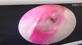 Vietnamese doctor removes poisonous ant from patient's ear canal