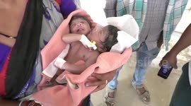 Woman gives birth to unique conjoined twins with 2 heads and 3 hands in eastern India