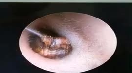 Vietnamese doctor removes cotton swab stuck in woman's ear