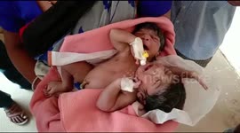 Conjoined twins born with two heads and three hands in Eastern india