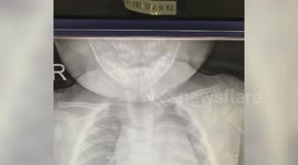 Chinese doctor removes pin from 7-month-old boy's body after he swallowed it
