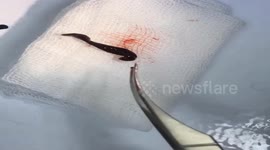 Vietnamese doctor removes live leech after it crawls up man's nose