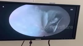 Vietnamese doctor removes live butterfly that had burrowed into man's ear