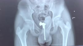 Doctor removes 68 magnetic balls from boy’s urethra in southern China