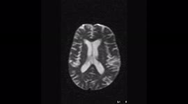 Brain C-spine 67Yrs  Male at 2FPS MRI scanning method medical
