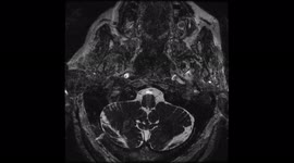 Brain MRA  75Yrs Female MRI Scanning method medical GE machine