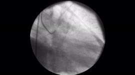 CAG+PTCA 67Yr Male 10FPS Angiography or arteriography is a medical imaging technique