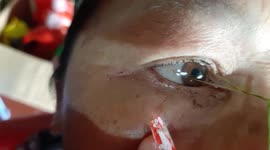 Vietnamese doctor removes dozens of parasitic flukes LIVING in patient's eyes