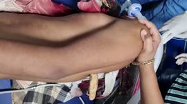 Graphic Content: Doctors save youngster after wooden log pierces through his body in central India