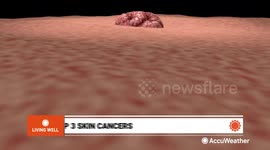 The top 3 most common forms of skin cancer