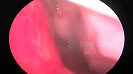 The doctor removed the leech that lived in the slit of the woman's nose for 1 month