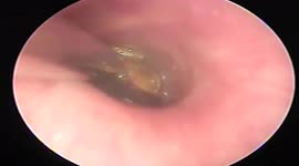 Two bugs attack and puncture man's eardrum