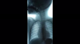Contrast test.  X-ray video
