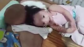 Filipina baby girl has large lump like a coconut growing from her head
