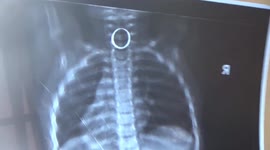 Toddler swallowed mother's ring was rushed to hospital in South India.