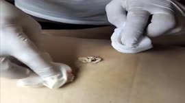 Vietnamese dermatologist removes 10-year-old giant pimple on man's stomach