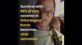 Survivor with 90% of skin covered in third degree burns becomes viral sensation on TikTok – sharing how he lives with injuries and deals with trolls who call him 'ugly'.