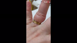 Canadian woman gets wedding ring cut off swollen finger after 18 years