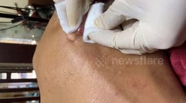Vietnamese dermatologist removed a giant pimple located behind a man's ear