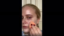 Woman who suffered with severe acne shares her story to help others