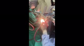 Awakened craniotomy surgery done on woman while she recite Hanuman Chalisa in central India.