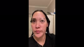 TikTok star's eyelashes and eyebrow turn white from rare vitiligo