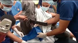 Doctors save Indian man whose chest was pierced by 2m metal rod