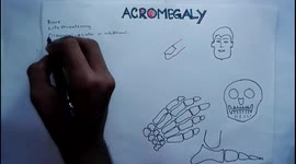 ACROMEGALY : Pathophysiology, Causes, Signs and symptoms, Treatment and everything.